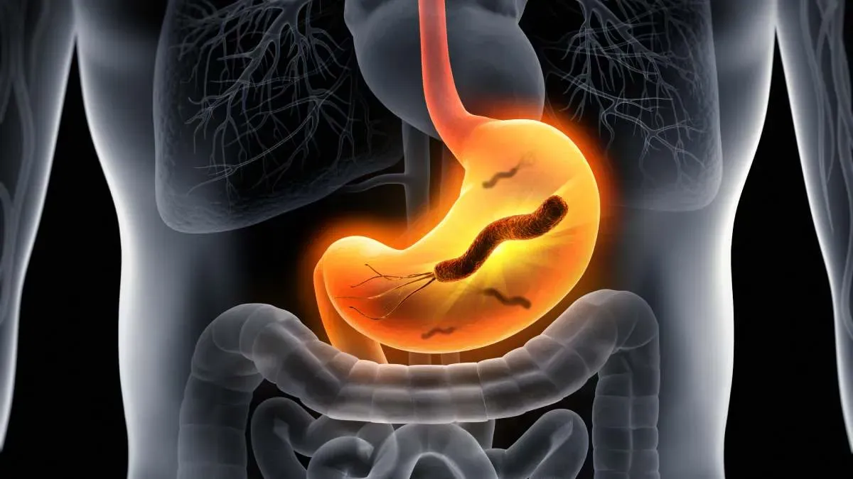 Imagen sobre "Infección por Helicobacter pylori"