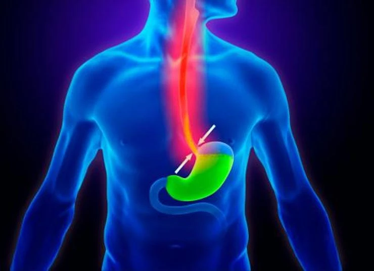 Imagen sobre "Reflujo Gastroesofágico y Acidez Crónica"