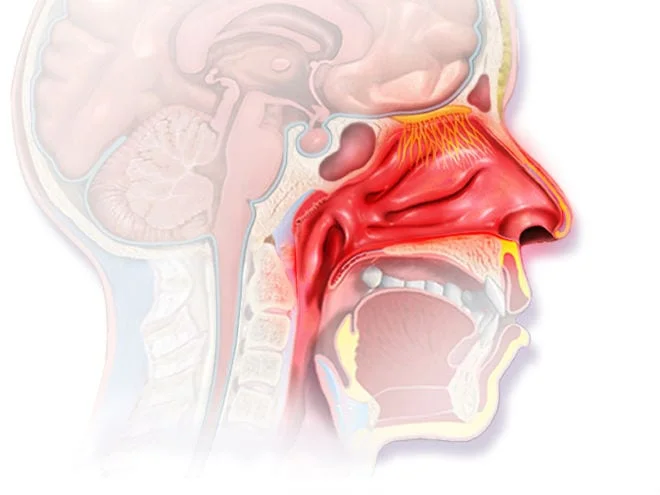 Imagen sobre "Rinitis alérgica y congestión nasal"