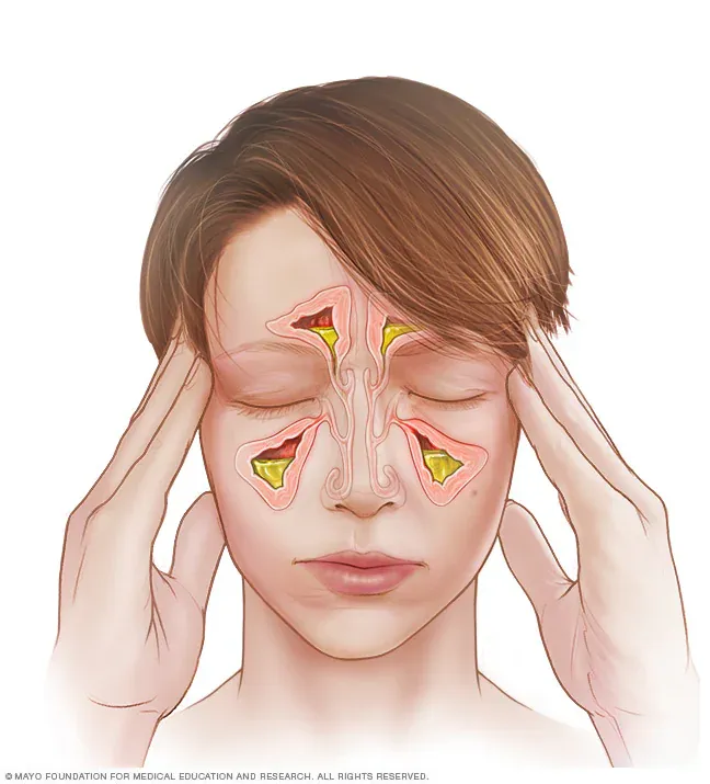 Imagen sobre "Sinusitis aguda y crónica"